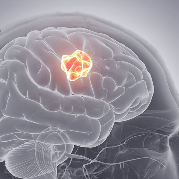 Beyin ve Omurilik Tümörleri